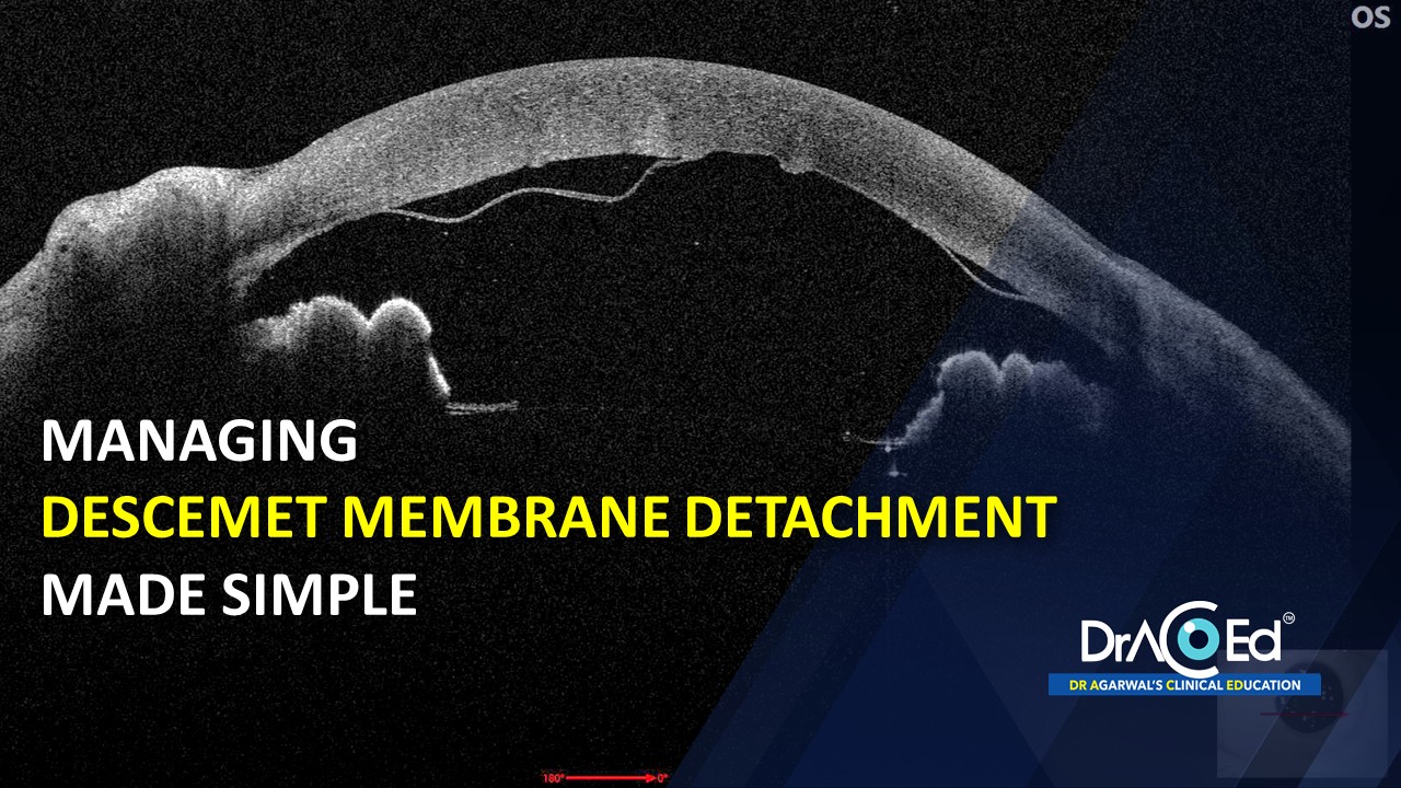 MANAGING DESCEMET MEMBRANE DETACHMENT MADE SIMPLE